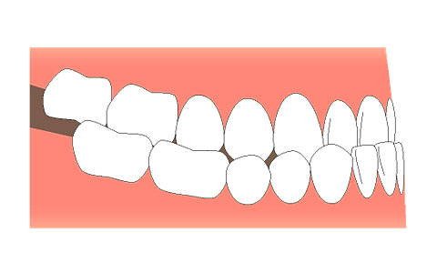 下 の 歯 が 前 に 出 てる 治し 方