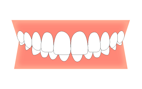 噛み合わせが深い 過蓋咬合 横山矯正歯科 公式サイト